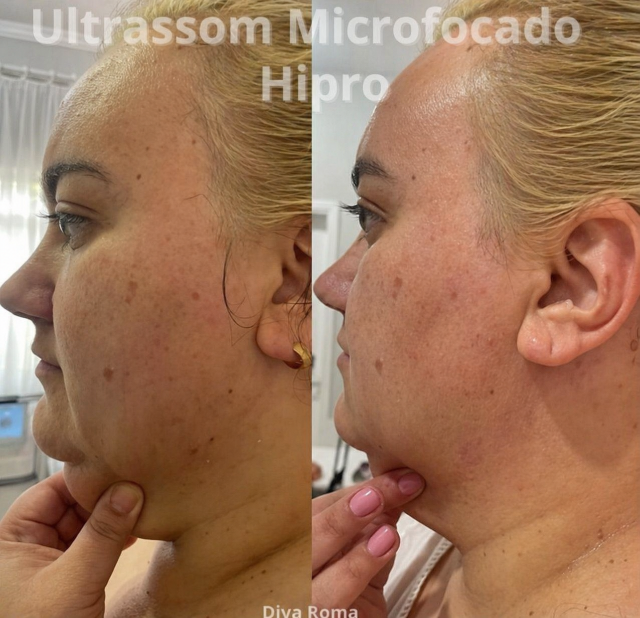 Resultado antes e depois 5